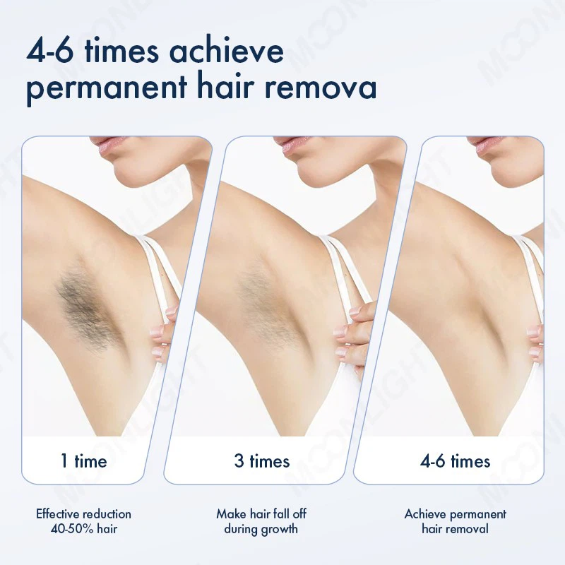 Nd YAG Diode Laser Hair Removal Machine Price