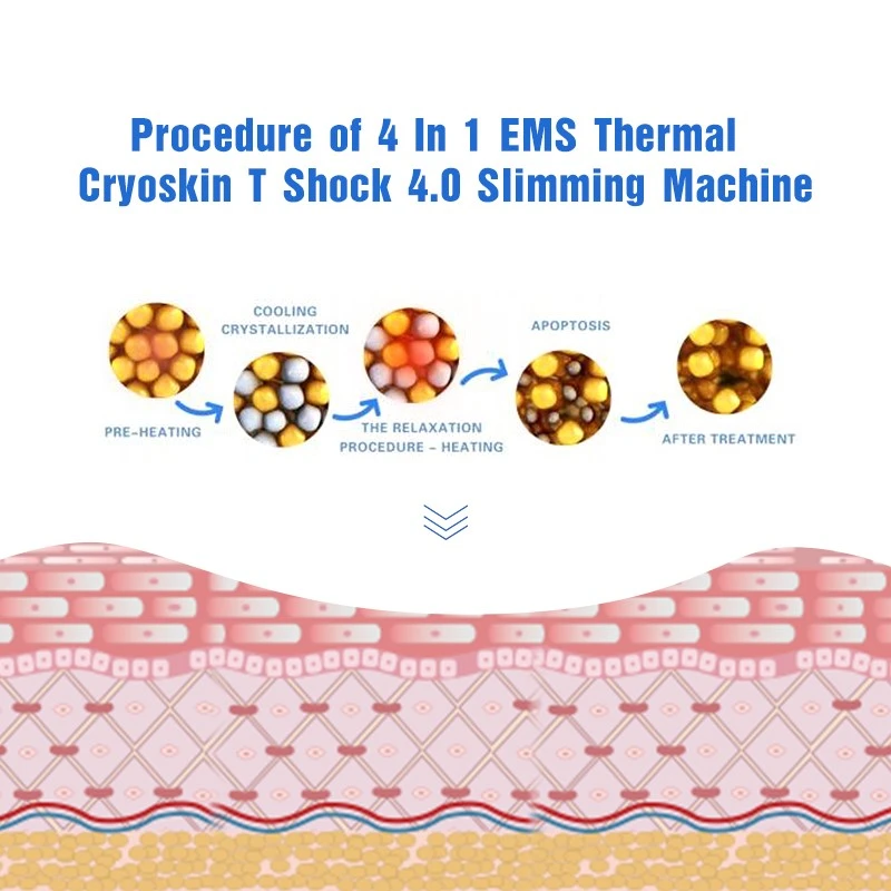 cryo slimming cryo slimming